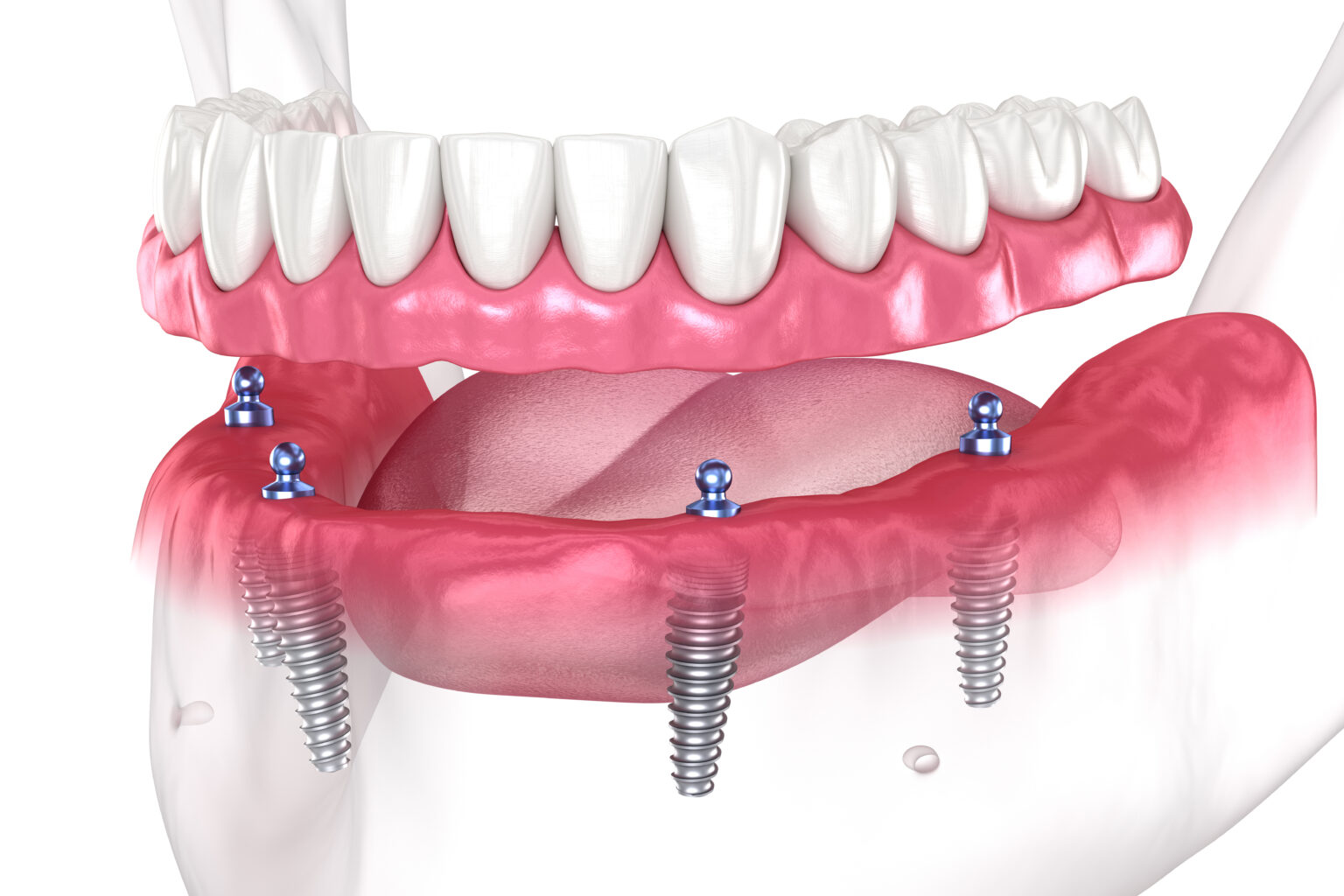 is-there-a-difference-between-a-temporary-prosthesis-and-a-final