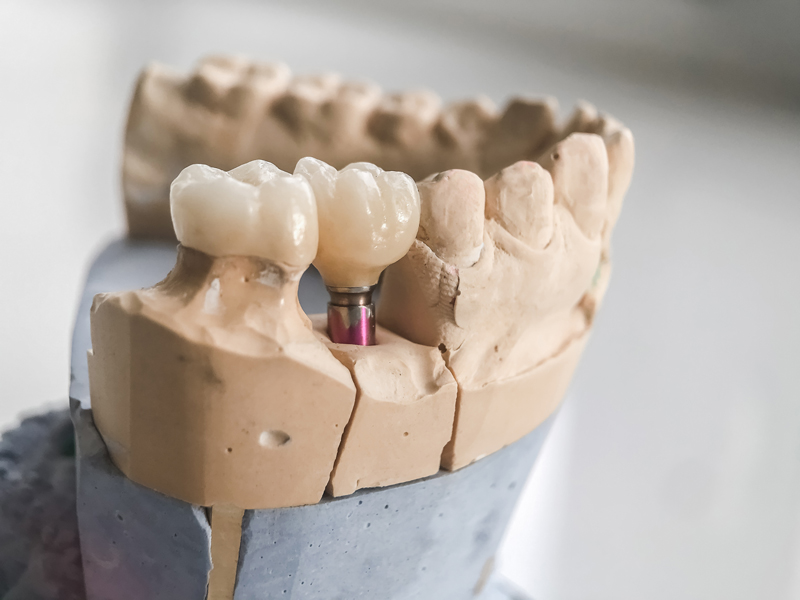 Image of a prosthesis jaw with a implant supported bridge